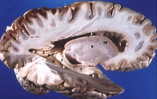 Human Brain Right Dissected Lateral View Description, Planeta Incógnito