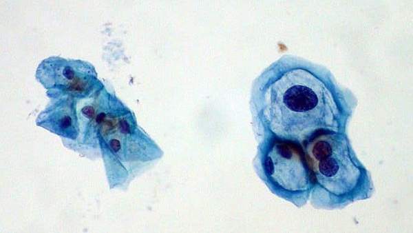 El Virus Del Papiloma Humano Esta Detras Del 10 De Los Canceres De La Mujer, Misterio y Ciencia en Planeta Incógnito: Revista web y podcast
